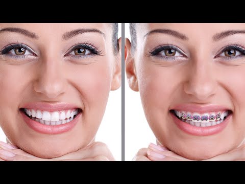 Aplicativos Para Colocar Aparelho Nos Dentes Pelo Celular